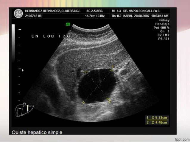 Quiste Hidatidico Hepatico Pdf
